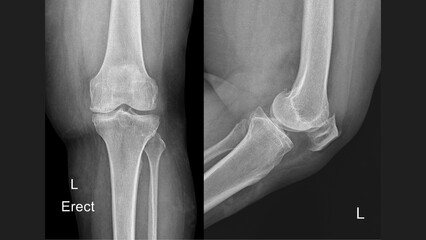 X-ray of left knee showing bone anatomy in AP and lateral views – erect position