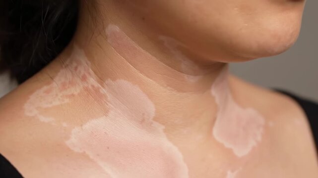 Vitiligo Patches on Neck and Chest - Close-up view of a person's neck and upper chest showing depigmentation patches consistent with vitiligo.