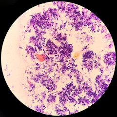 Paps smear: NILM with fungal infection caused by candida species.