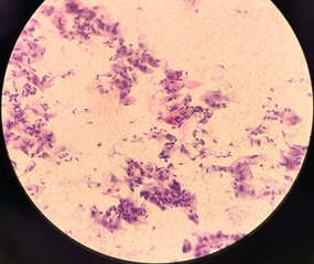 Paps smear: NILM with fungal infection caused by candida species.