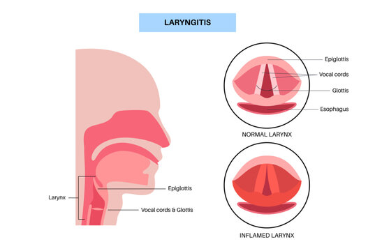 Laryngitis medical poster