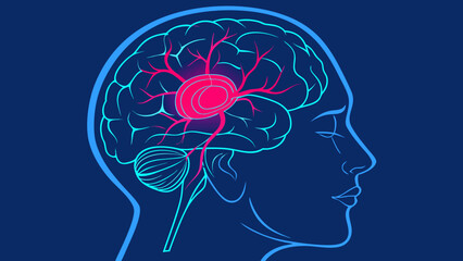 Brain aneurysm illustration showing blood vessel swelling
