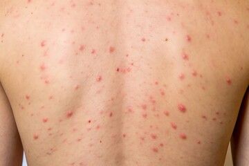 Close up view of a person s back covered in red spots and blemishes