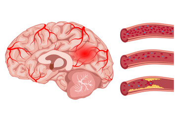 Brain damage, cerebrovascular disease, brain injury, stroke, blood flow disorder