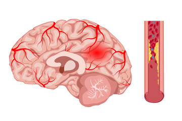 Cerebrovascular disease, stroke, brain, blood vessel blockage