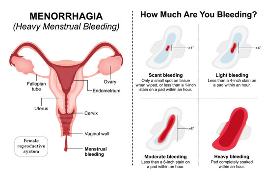 Heavy Menstrual Bleeding (Menorrhagia) flashcard illustration