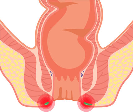 Perineal Abscess 