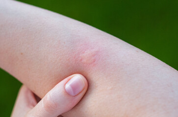 Red Itchy Mosquito Bite on Hand