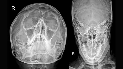 Skull X-ray with PNS and Reverse Towne Views Showing Paranasal Sinuses and Facial Bone Structures