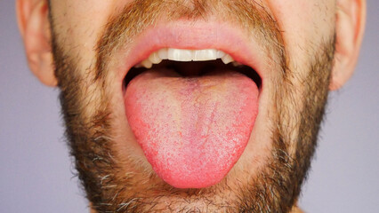 Close-up of a mans tongue sticking out with a white coating