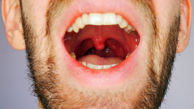 Close-up of a mans open mouth showing his sore throat