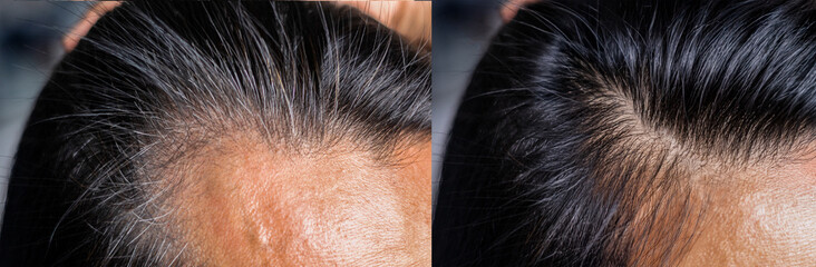 Before and after comparison of a woman with hair loss due to alopecia, showing visible hair...