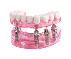 3D rendering of dental implants securing a lower denture.  Pink gums, teeth, and clear jaw.  Visible dental implants