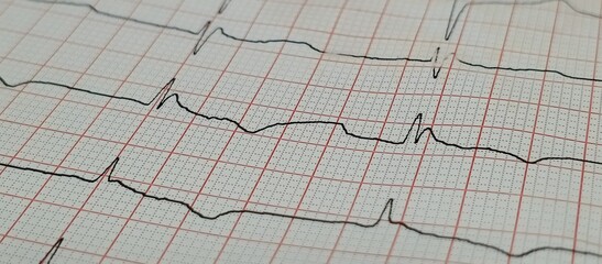 Electrocardiogram printout showing heart waveforms on grid paper, symbolizing cardiac diagnostics, arrhythmia detection, and clinical care