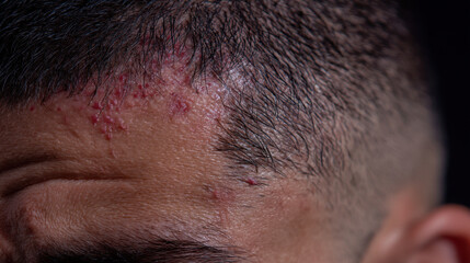 Close up view of person scalp showing minor skin irritation and blemishes. image captures texture of hair and skin, highlighting redness and imperfections