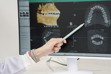 Asian female dentist hand pointing with stylus at panoramic dental xray image on computer monitor during oral examination consultation in modern diagnostic clinic room