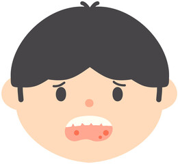 Mouth Ulcer and Canker Sore Medical Illustration