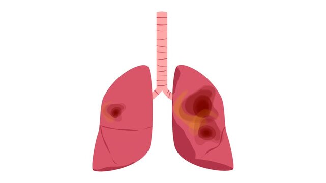 Pneumonitis. Lung disease illustration animation. Respiratory disease
