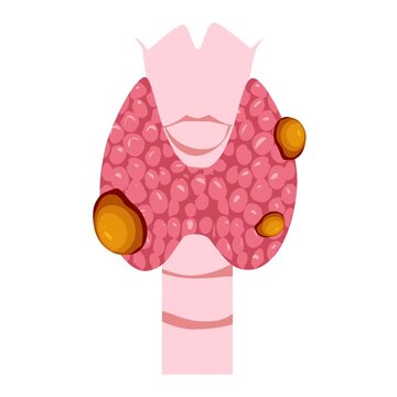 Thyroid disease illustration animation. Thyroid cancer
