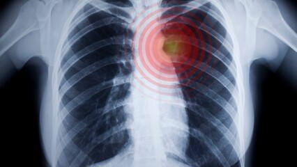 Lung Cancer Detected on X-Ray Medical Imaging and Diagnosis
