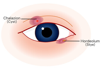 Hordeolum, chalazion. Swellings caused by the obstruction or inflammation of the sebaceous glands in the eyelid. Hordeolum is a common painful infection of the eyelid margin. Vector illustration