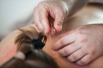 Chinese medicine. Close-up of a doctor's hands doing acupuncture