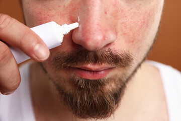 Young man with acne problem applying cream onto his face on brown background, closeup