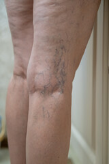 Fototapeta premium Venous disease - varicose veins. A mature woman is taking care of her legs. Back view of knee - Popliteal fossa. Foot care.