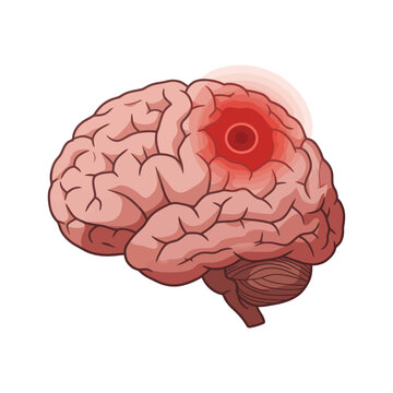 brain injury shows trauma impact highlighting medical issues and stroke prevention needed for health awareness campaigns