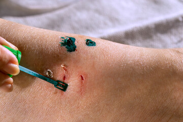 Woman applying treatment with medical spatula on leg wound after cat bite. Skin care and first aid process.