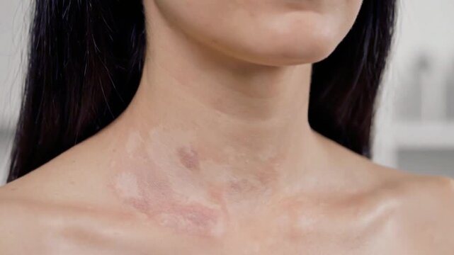 Tinea Versicolor symptoms showing skin infection and dermatology condition. Generative AI