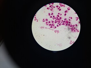 Intracellular Neisseria gonorrhoeae bacteria with gram staining, viewed under a microscope.