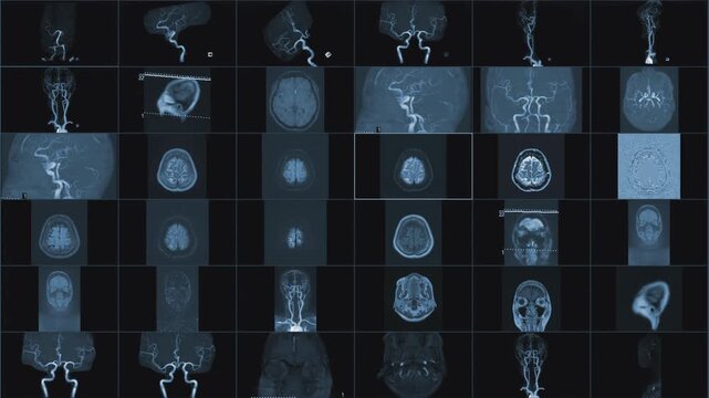 Magnetic resonance images of the brain (MRI of the brain) of a patient with multiple vascular infarctions, 6x6 image grid, black and white animation Seamless Loop. High quality 4k footage
