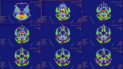 Magnetic resonance images of the brain, MRI of the brain, of a patient with multiple vascular infarctions, front view, color animation Seamless Loop. High quality 4k footage