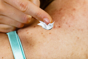 Woman with pimple on back applying medical ointmeny