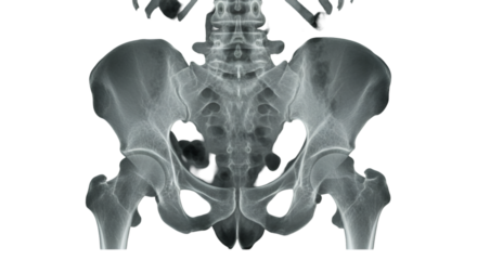 Unveiling the skeletal secrets within an X ray glimpse into the human hips and pelvis revealing intricate bone