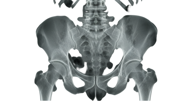Unveiling the skeletal secrets within an X ray glimpse into the human hips and pelvis revealing intricate bone