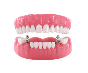 Obraz premium Dental implant dentures, showing teeth and gums. Two metal implants secure the upper denture