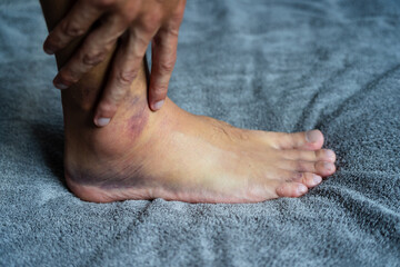 Fototapeta premium Close-up of a man's hand gently touching a swollen, bruised ankle resting on a grey towel, highlighting the pain and discomfort of a sprained ankle