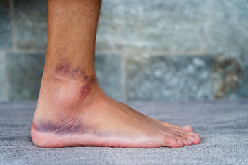 Close-up of a bruised and swollen ankle resting on a gray towel, highlighting the effects of a sprain