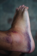 Close-up of a bruised and swollen ankle, highlighting the discoloration and inflammation resulting from a sprain