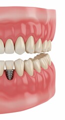 Close up of a dental implant with a screw visible in the gum line next to healthy teeth