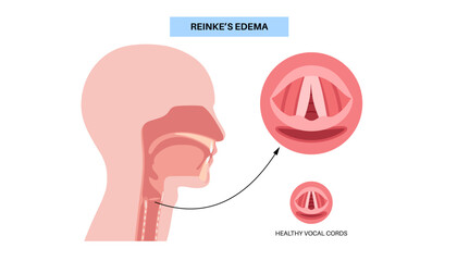 Reinkes edema poster
