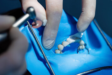 Close-up of dentist hands using dental drill with polishing disc to finish bonded veneer. Concept of cosmetic dentistry, smile design, and professional tooth restoration.