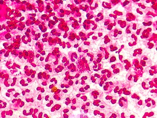 Intracellular Neisseria gonorrhoeae bacteria with gram staining, viewed under a microscope.