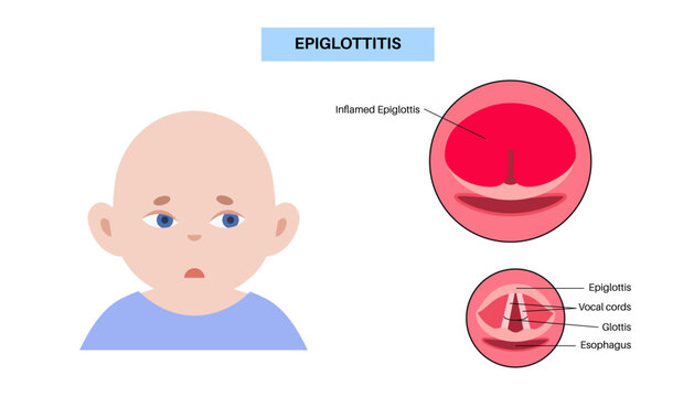 Epiglottitis medical poster