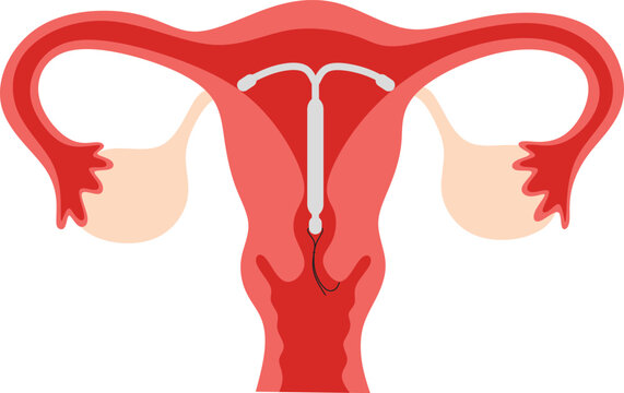 Illustration of intrauterine contraceptive device (IUD) installation
