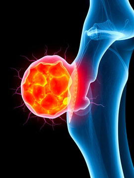 tumor cell with hip femur with The Ewing's sarcoma gross leg bone pain and soft tissues gene mutation chromosomal inflammation of chondrosarcoma by needle transplant