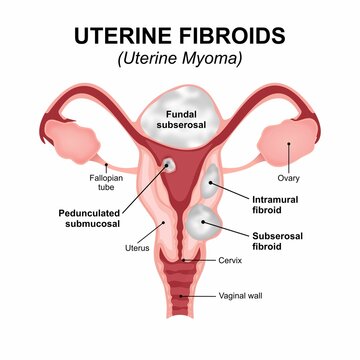 Uterine fibroids - uterine myoma medical flashcard illustration