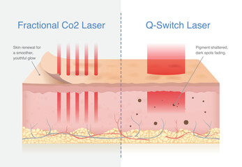 Effects of Fractional CO2 Laser vs Q Switch Laser on Skin Layers. Fractional CO2 laser resurfacing skin, promoting renewal for smoother. Q Switch laser shatters pigment, fading dark spot.

